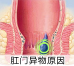 肛门口长东西是痔疮吗